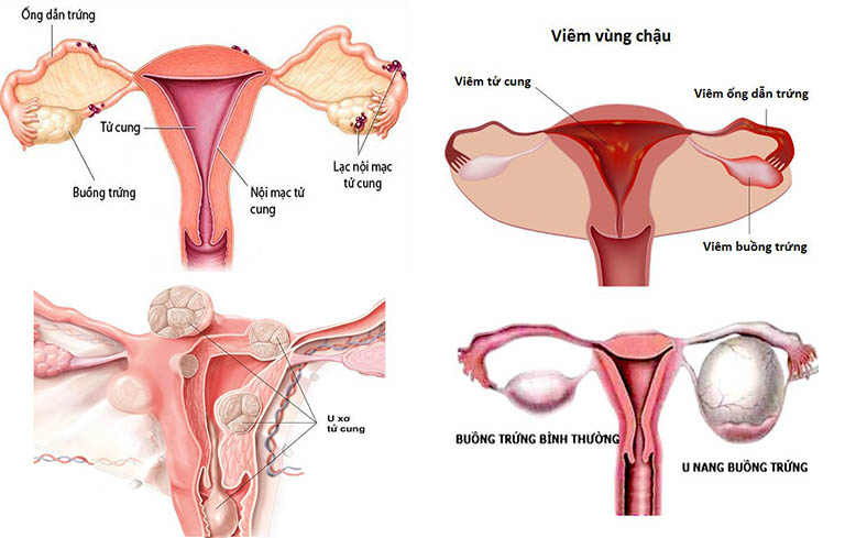 Việc nạo hút thai gây ra tình trạng rong kinh khi tử cung, buồng trứng bị tổn thương càng khiến cho các cơ quan sinh dục này dễ viêm nhiễm nặng