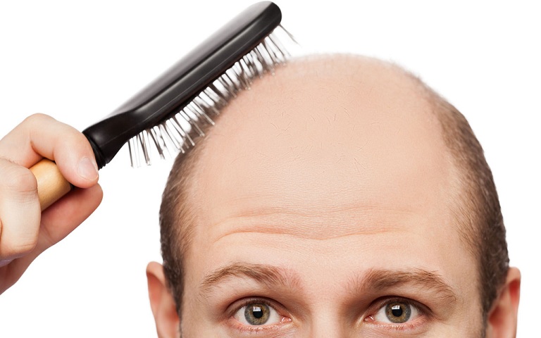 Rụng tóc ở nam giới là bệnh gì?