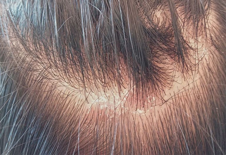 Các loại thuốc đặc trị nấm da đầu thông dụng nhất