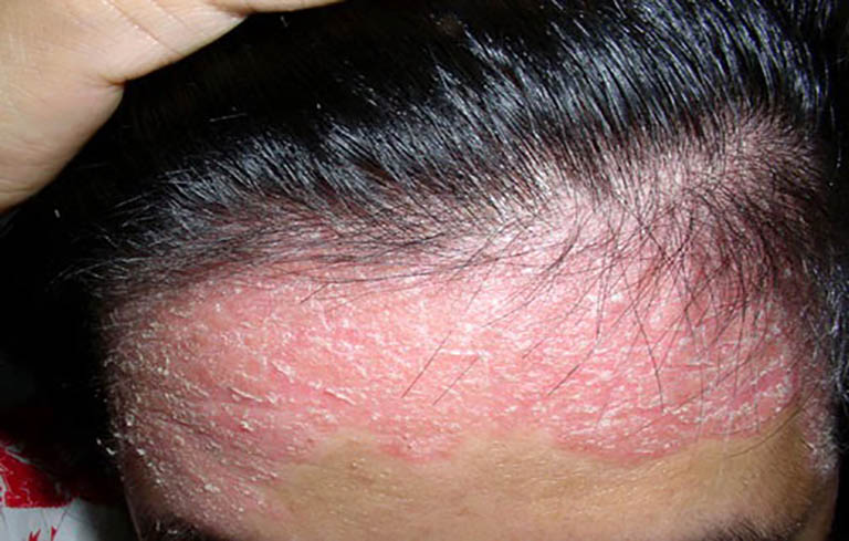 Phương pháp điều trị bệnh vảy nến da đầu hiệu quả