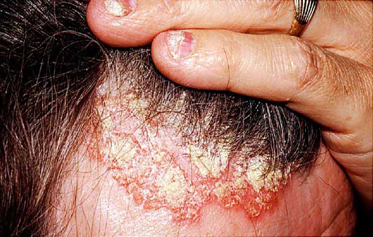 Vảy nến da đầu không có lây qua đường tiếp xúc nhưng dễ lan rộng ra các vùng da xung quanh của người bệnh