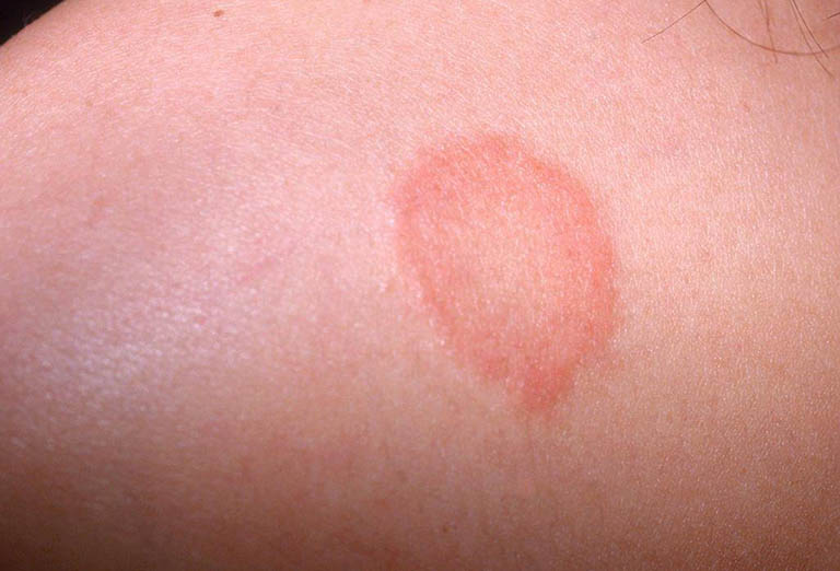 Vết tròn đỏ trên da không ngứa là bệnh gì? Nguy hiểm không?
