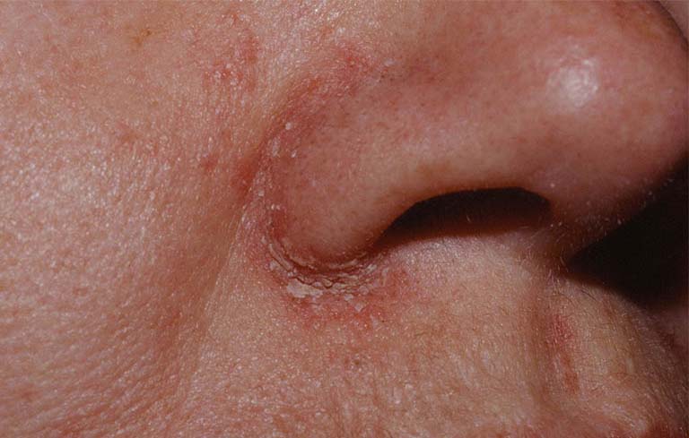 Hình ảnh viêm da dầu ở cánh mũi