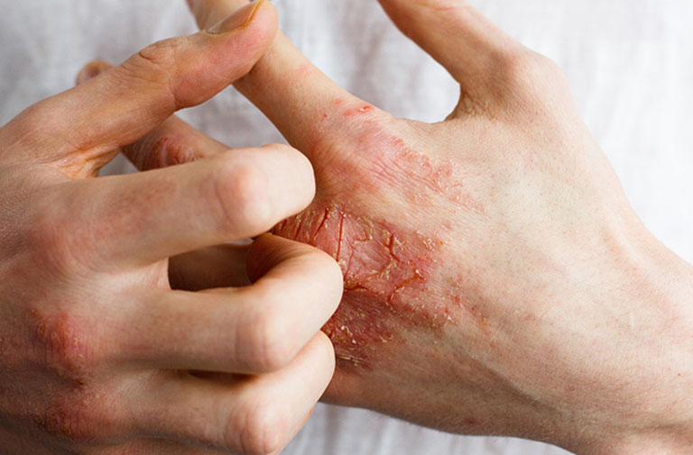 Viêm da tiếp xúc bội nhiễm gây bong tróc ngứa rát khi chuyến sang giai đoạn mạn tính