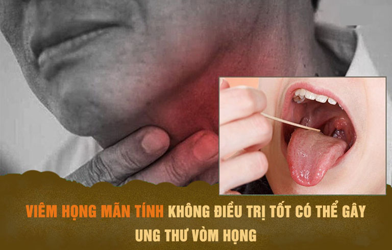 Viêm họng mãn tính có thể không chữa trị tốt dễ gây ung thư vòm họng