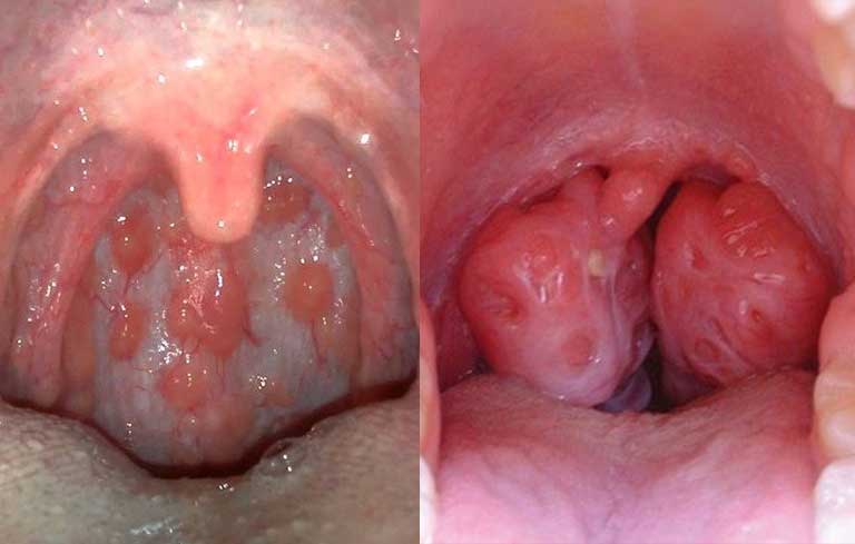 Viêm họng hạt, viêm amidan là những biến chứng thường gặp của viêm họng mãn tính