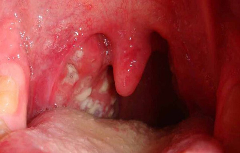 Triệu chứng bệnh viêm họng mủ ở trẻ em