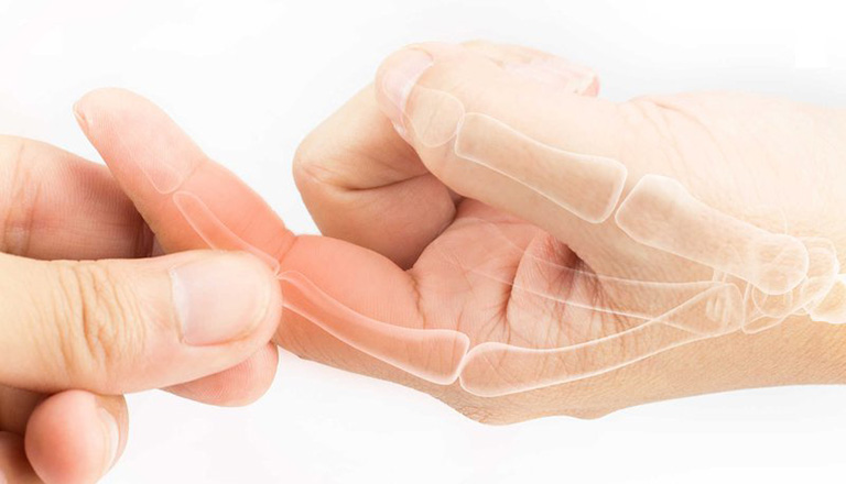 Viêm khớp ngón tay là bệnh lý xảy ra khá phổ biến hiện nay