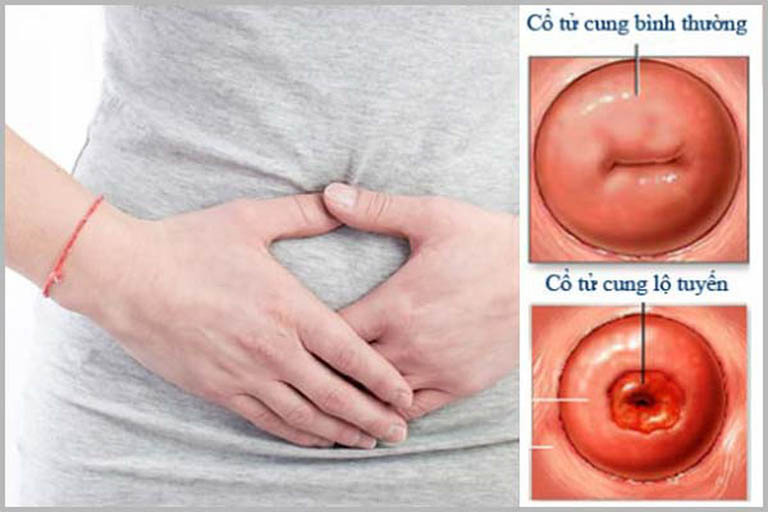 So sánh cổ tử cung bình thường và cổ tử cung của người mắc bệnh