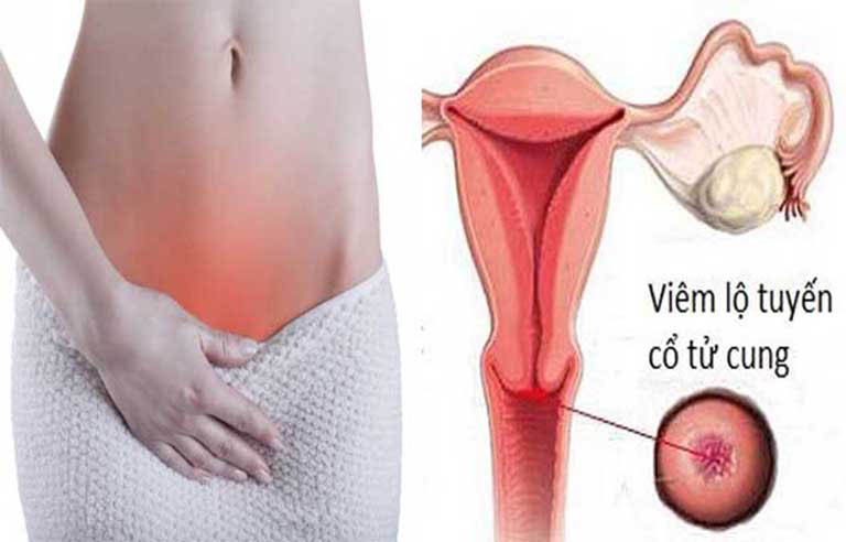 Biểu hiện của viêm lộ tuyến cổ tử cung ở nữ giới