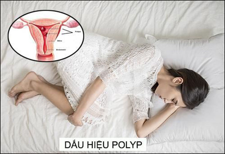 Dấu hiệu nhận biết viêm polyp cổ tử cung