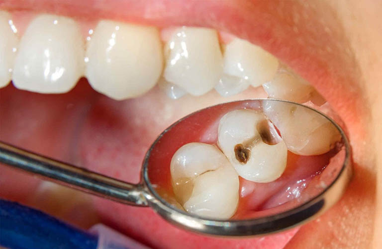 Sâu răng