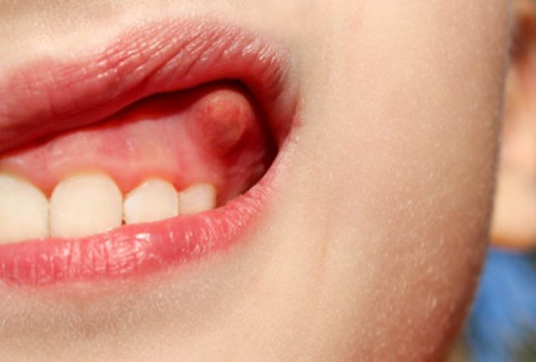 Áp xe răng là gì? Nguyên nhân và các phương pháp điều trị