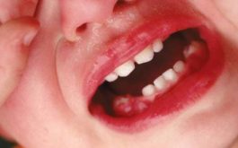 Trẻ bị đau nhức khi lợi bị sưng và có mủ. Nếu kèm sốt lá dấu hiệu nhiễm trùng nặng.