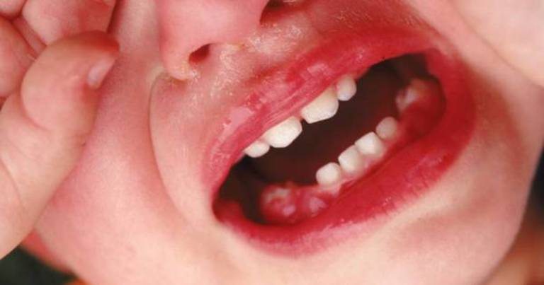 Trẻ bị đau nhức khi lợi bị sưng và có mủ. Nếu kèm sốt lá dấu hiệu nhiễm trùng nặng.