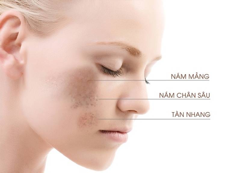 cách chăm sóc da mặt bị nám tàn nhang