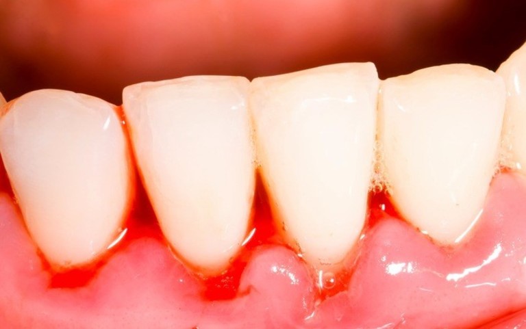Chân răng bị chảy máu do bệnh lý thường gây nhiều hệ lụy khôn lường. Điều trị không khó nếu phát hiện sớm.