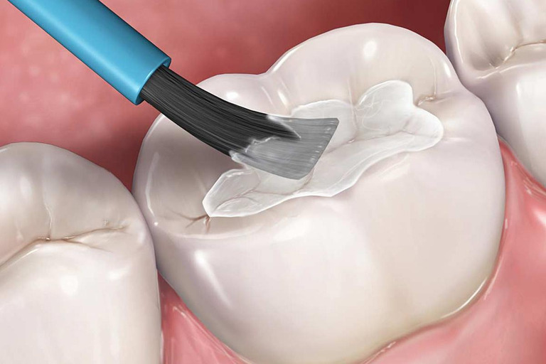 Trám răng chữa ê buốt kéo dài thường dùng khi lỗ hổng trên răng nhỏ.
