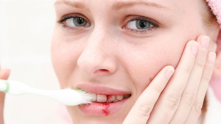 Đánh răng bị chảy máu do đâu? Nên làm gì?