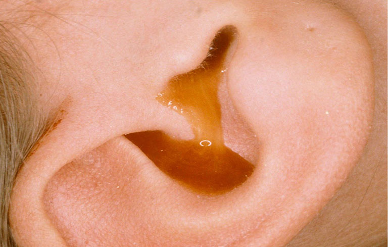 Dấu hiệu viêm tai giữa điển hình