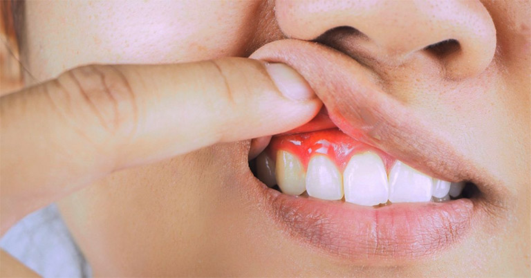 Bệnh viêm nướu răng là một trong những bệnh lý có diễn biến khá phức tạp trong số bệnh trong khoang miệng