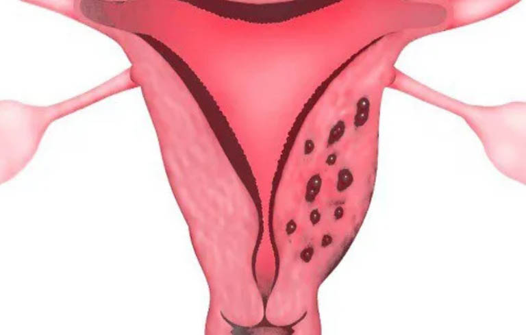 Lạc nội mạc tử cung là bệnh phụ khoa phổ biến hiện nay