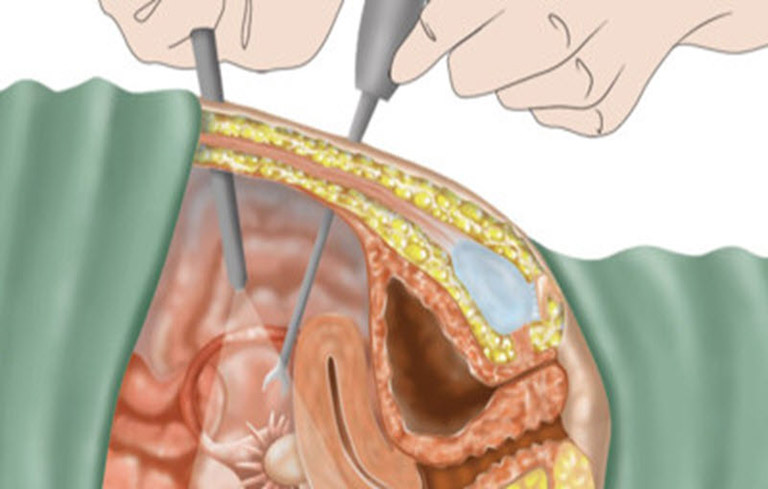 Phẫu thuật lạc nội mạc tử cung là biện pháp hiệu quả để loại bỏ các mảng nội mạc
