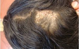 Bệnh nấm da đầu nặng ảnh hưởng đến sức khỏe thế nào?