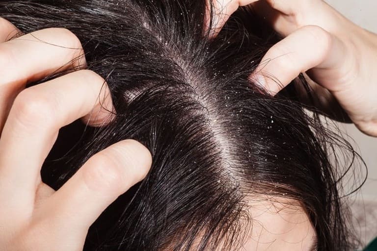 Nấm da đầu nặng ảnh hưởng đến sức khỏe như thế nào?