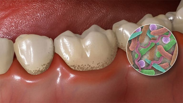 Sự tích tụ các mảng bám ở chân răng tạo điều kiện cho vi khuẩn phát triển và khiến lợi bị viêm.