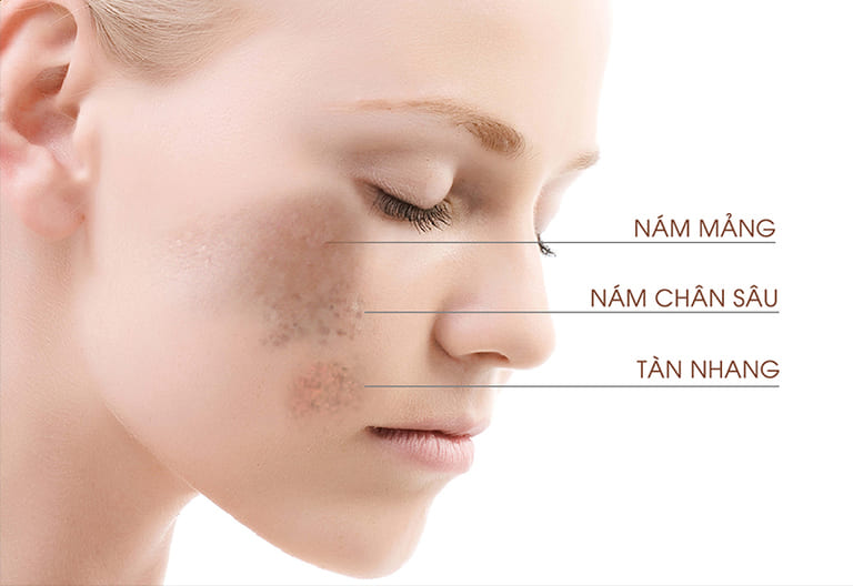 Nám da bắt nguồn từ sâu bên trong các các lớp da. Trong khi tàn nhang chỉ xuất hiện ở bề mặt.