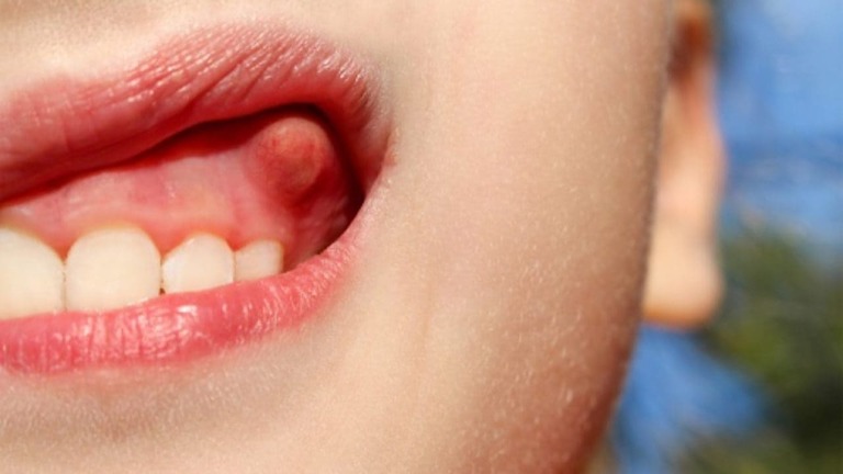 Nhổ răng bị áp xe có nguy hiểm không và khi nào thì nên nhổ