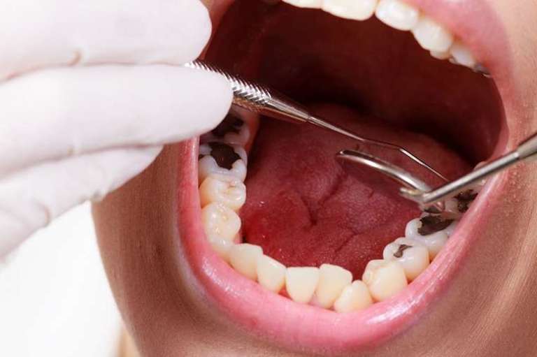 Nhổ răng cấm bị sâu sẽ tác động đến toàn bộ hàm. Vì thế điều trị bảo tồn luôn được ưu tiên.