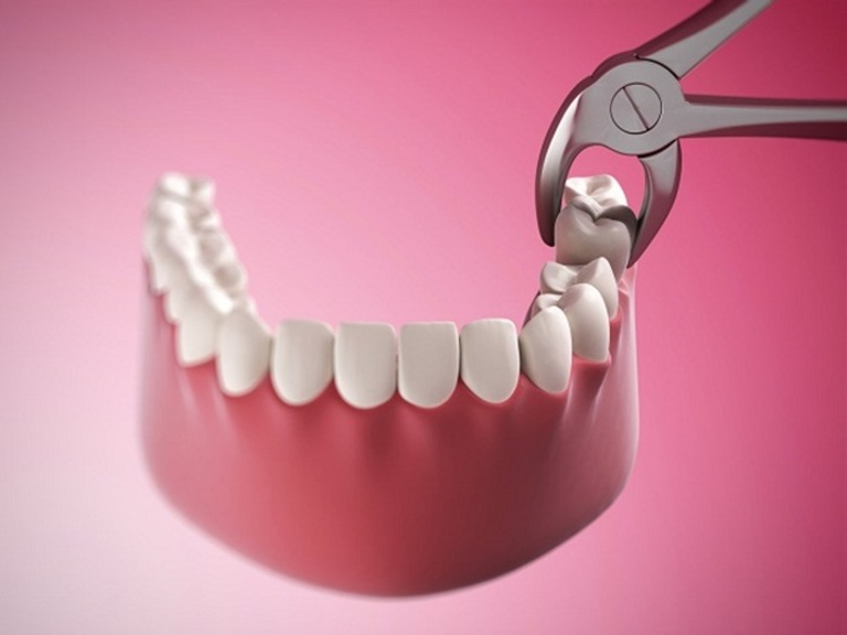 Nhổ răng cấm bị sâu là mối bận tâm của rất nhiều người bởi tình trạng này khá phổ biến.