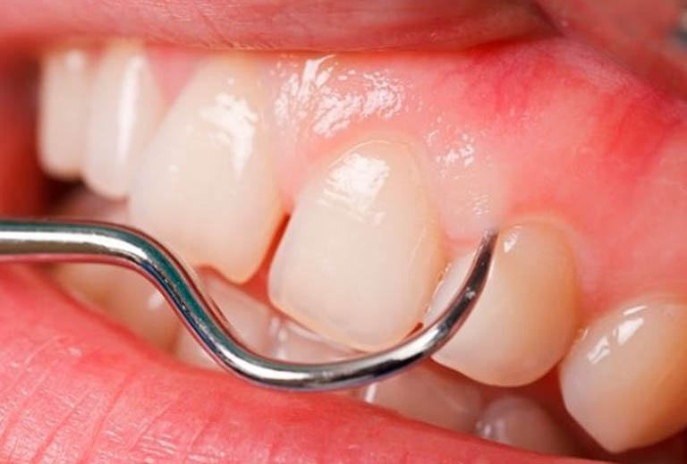 Nướu răng là gì? Cấu tạo, chức năng của nướu răng