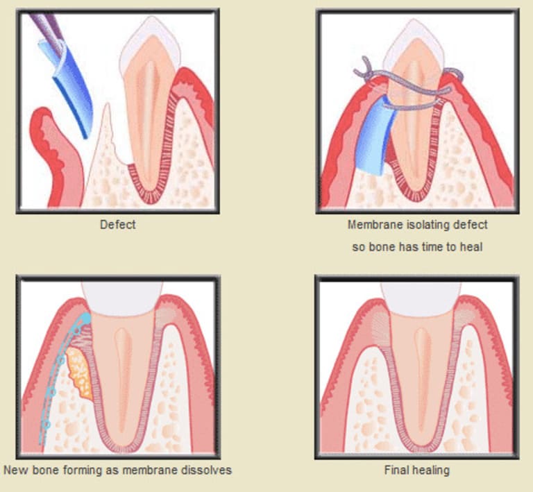 Phẫu thuật tái tạo xương và hồi phục mô áp dụng trong trong trường teo nướu răng nặng.