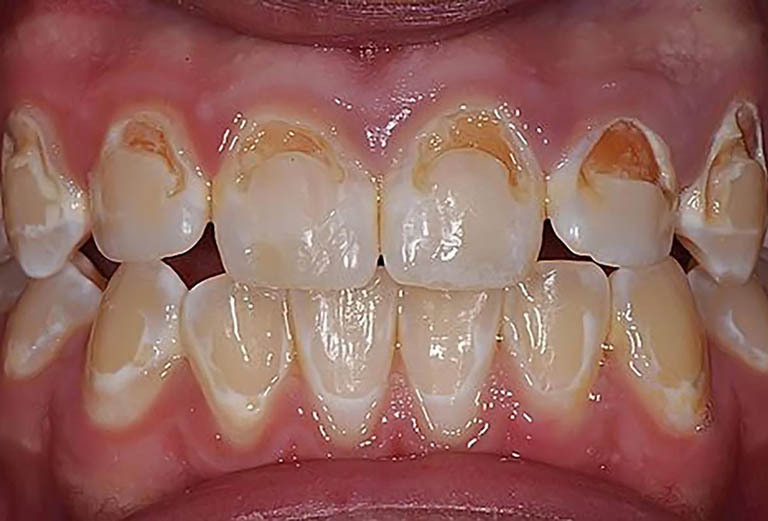 Men răng bị hỏng hoặc bị mòn