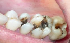 Răng hàm bị sâu chỉ còn chân răng có nên nhổ bỏ không và phải làm thế nào là mối quan tâm của rất nhiều người.