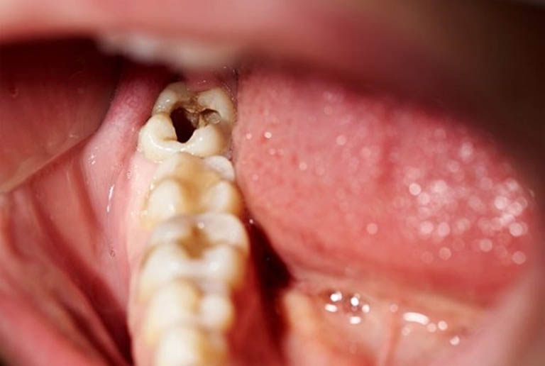 Răng khôn bị sâu có nên nhổ không? Biện pháp khắc phục nào tốt?