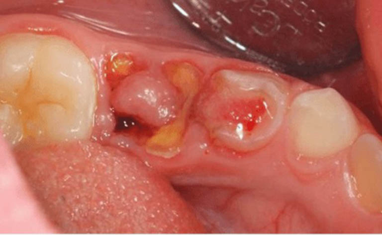Răng sâu lồi thịt: Nguyên nhân và cách điều trị dứt điểm