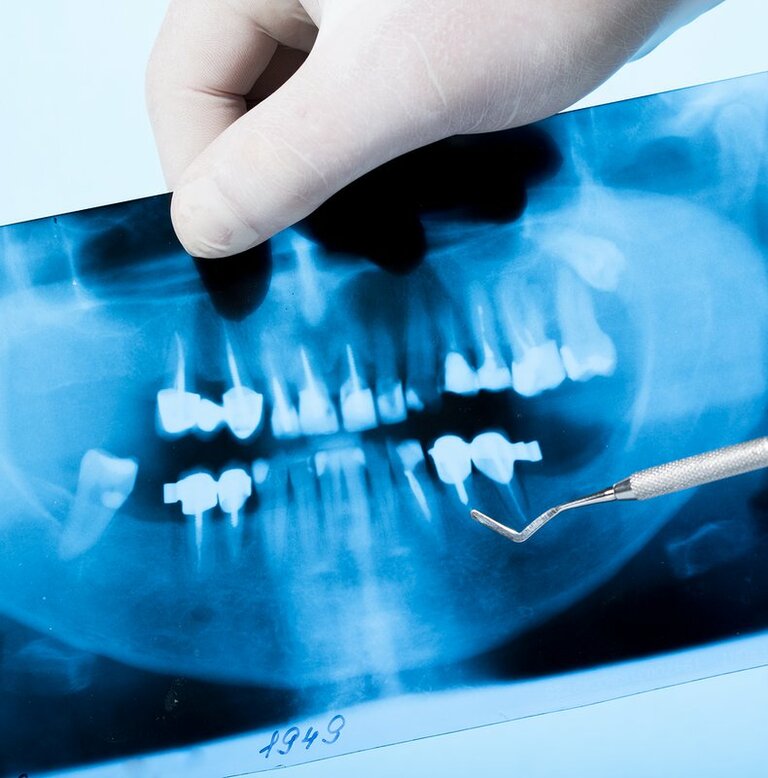 Chụp X - quang điều trị viêm tủy răng cho bà bầu được thực hiện với kỹ thuật đặc biệt nên an toàn cho mẹ và bé.