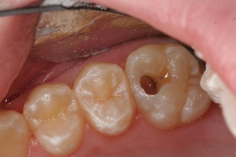 Sâu răng có lây không? Có di truyền không?