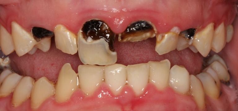 Sâu răng có nguy hiểm không? 