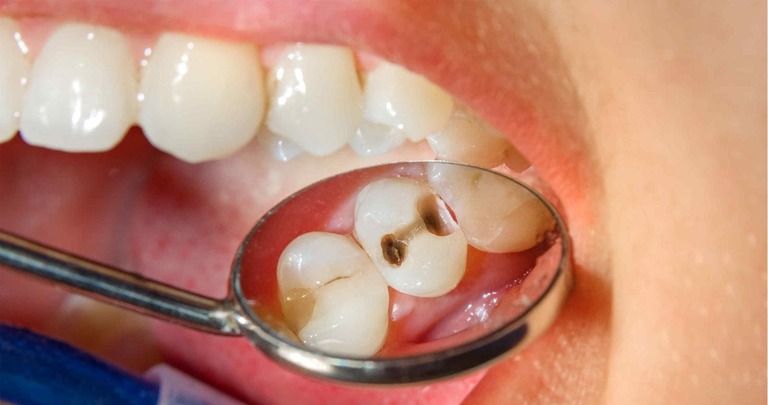 Sâu răng có nguy hiểm không? Có phục hồi được không?
