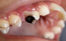 Sâu răng hàm và cách chữa trị hiệu quả, tiết kiệm chi phí