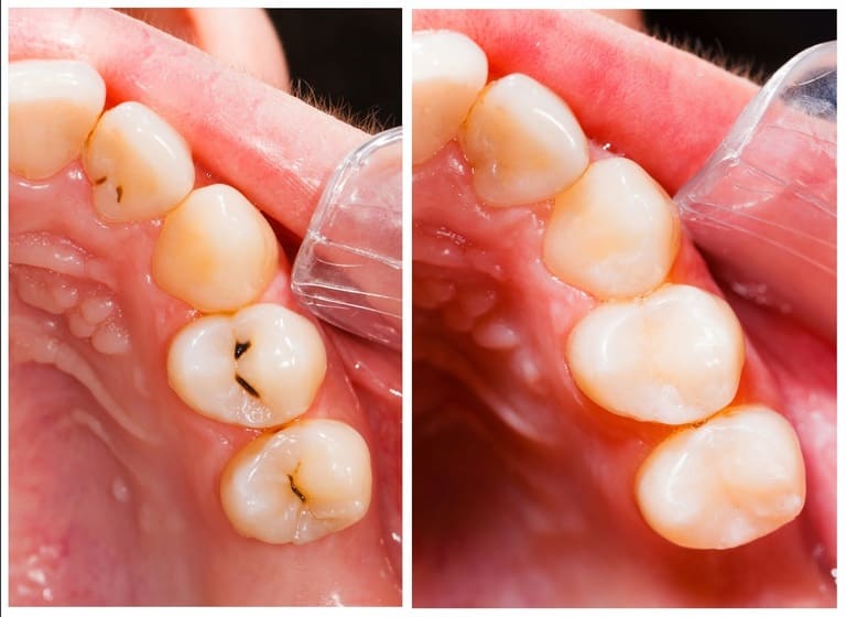 điều trị sâu răng hàm 