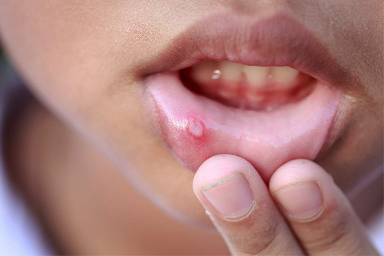Vết loét trên miệng do nhiệt miệng gây ở trẻ là những vết loét màu hồng, viền màu đỏ, có hình tròn hoặc hình oval
