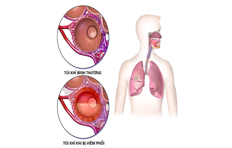 Viêm phổi ở trẻ sơ sinh