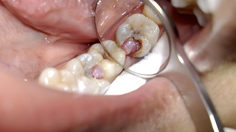 các nguyên nhân viêm tủy răng