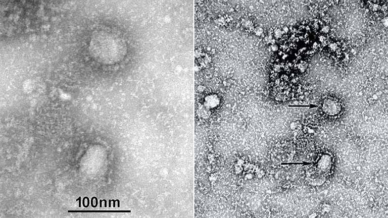 Hình ảnh virus Corona qua kính hiển vi